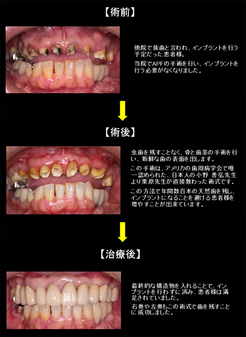 インプラントの前に！根管治療・ＡＰＦで歯を残そう！　インプラントの前に秩父臨床デンタルクリニック　埼玉県秩父市の歯医者　ＡＰＦ治療症例1