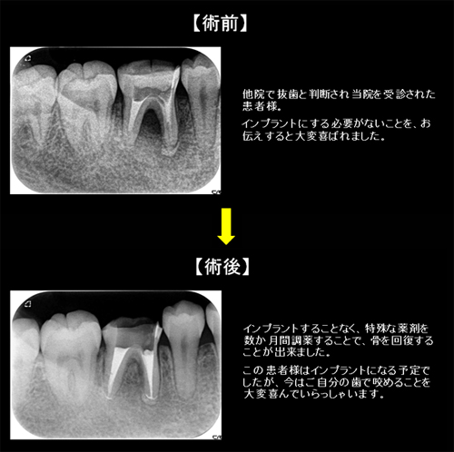 インプラントの前に！根管治療・ＡＰＦで歯を残そう！　インプラントの前に秩父臨床デンタルクリニック　埼玉県秩父市の歯医者　根管治療症例2